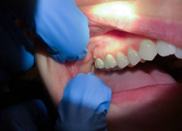 Best Emergency Wisdom Teeth Removal in Arlington Heights, WA